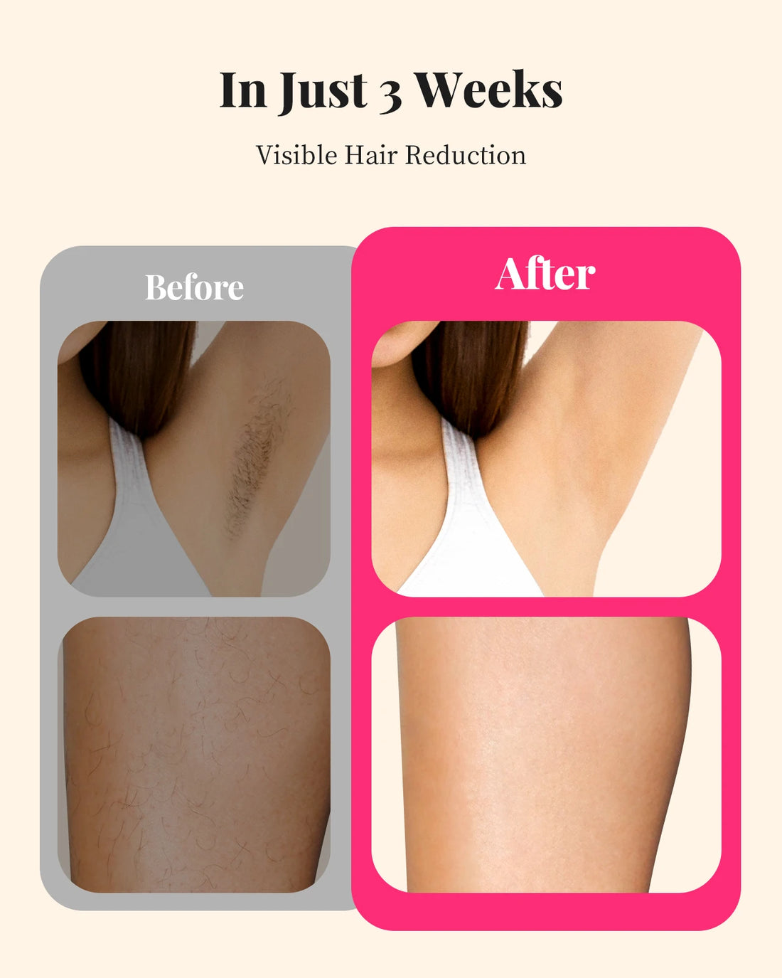 Advanced IPL Laser Hair Removal Device – Gentle & Permanent Smooth Skin
